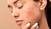 چگونه پوست چرب خود را کنترل کنیم و از جوش زدن جلوگیری کنیم؟ توضیحات یک متخصص پوست